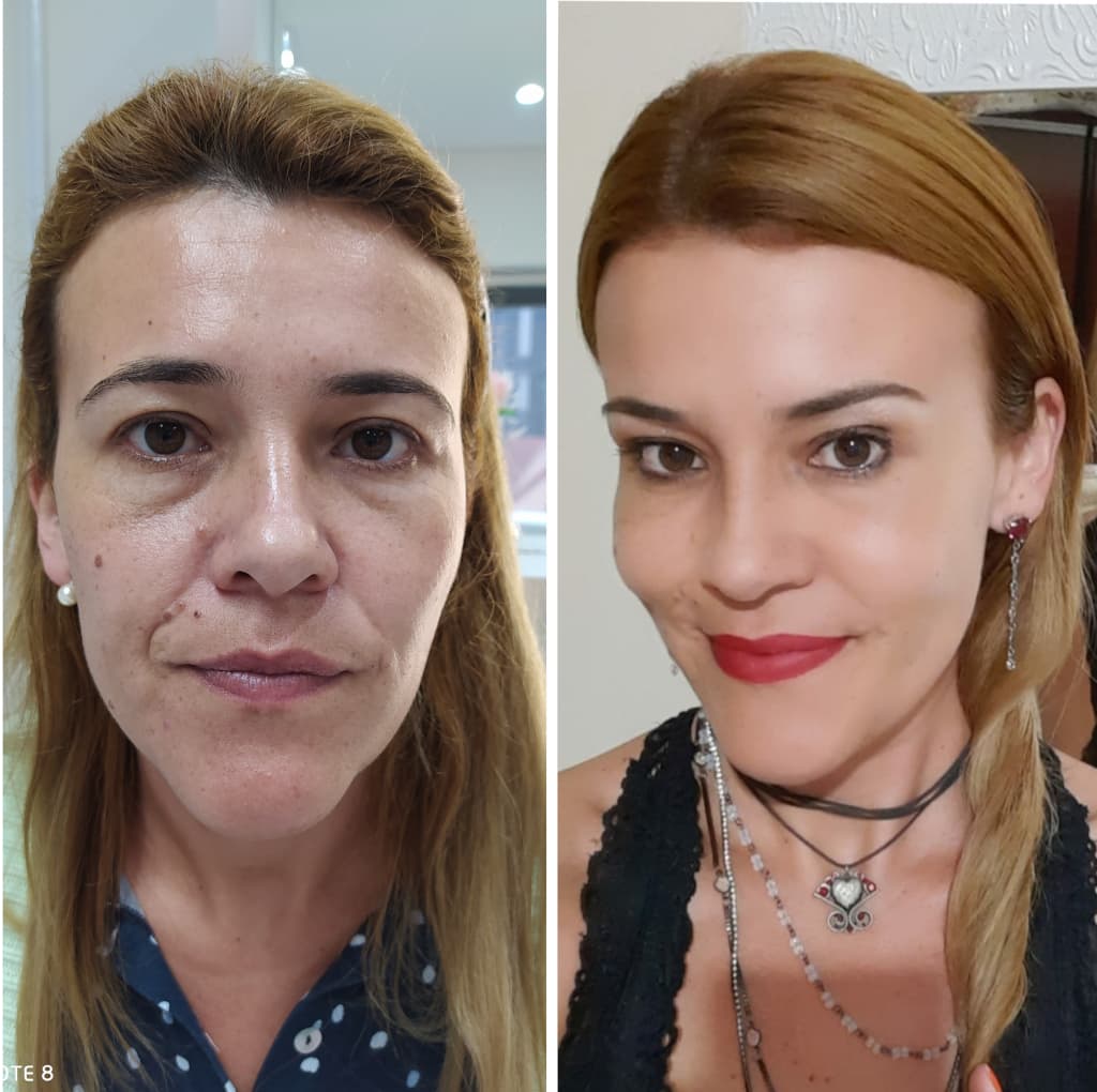 Antes e depois de uma paciente de fios de pdo