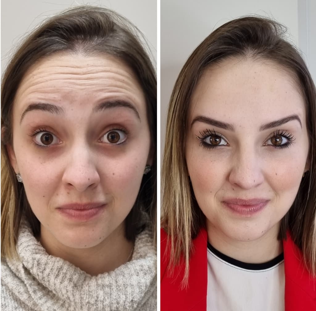 Antes e depois de uma paciente de toxina botulínica