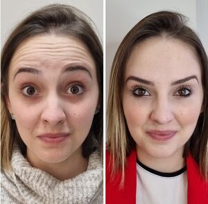 Aplicação de toxina botulínica (botox) para rugas e linhas de expressão em Curitiba - Dra. Jociene Andrade especialista em gerenciamento do envelhecimento